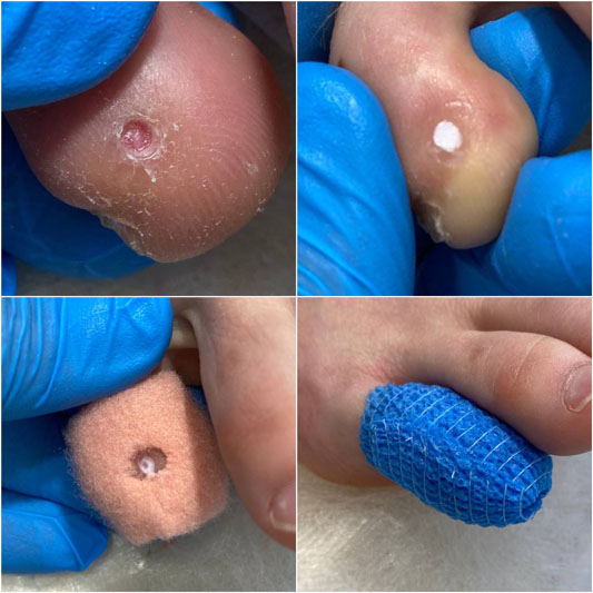 Лікування грибка нігтів і стоп