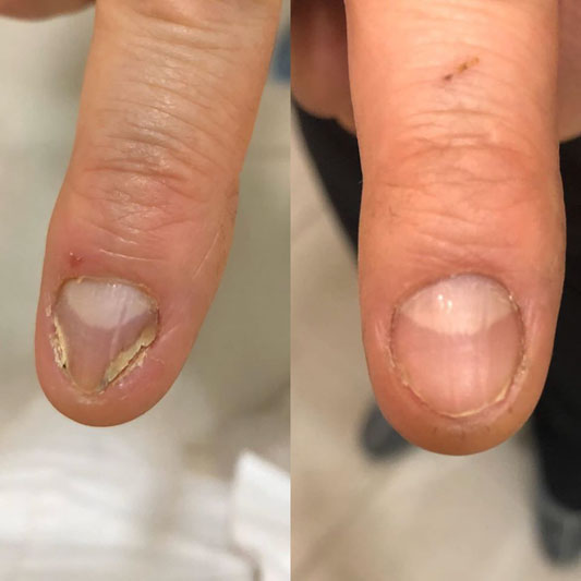 Лікування грибка нігтів лазером