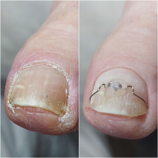 Лікування грибка нігтів і стоп