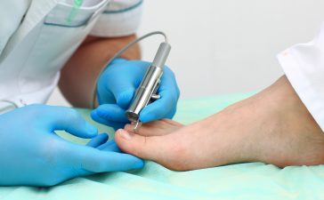 Лікування грибка нігтів (оніхомікоз) лазером