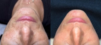 Видалення пігментації IPL Lumecca у Києві: чи ефективно і де краще робити?