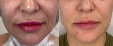 Morpheus8 у Києві: як підтягнути шкіру обличчя і тіла без операції