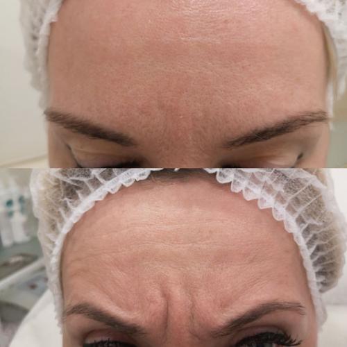 Корекция-морщин-Botox-Кальянова-Виктория-Дезидеровна25