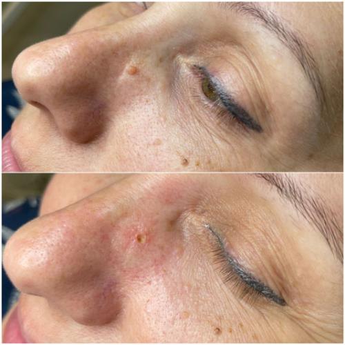 Видалення-новоутворень-Бесєда-Тетяна-Павлівна3