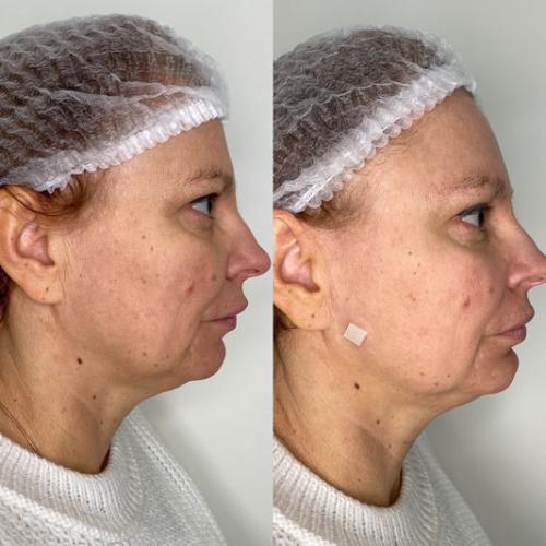 Омолодження-обличчя-Full-Face-3