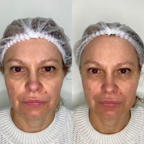 Омолодження-обличчя-Full-Face-4