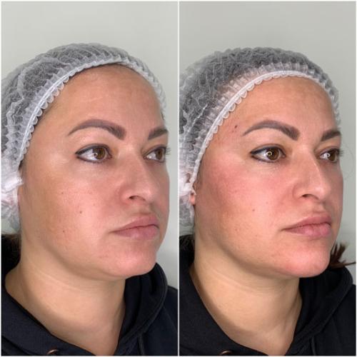 Омолодження-обличчя-Full-Face-5