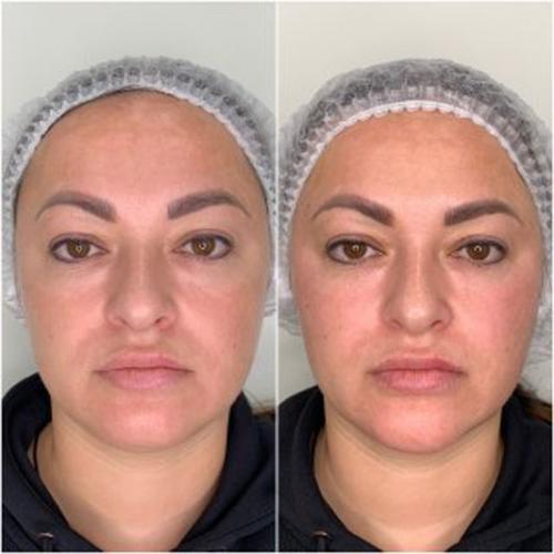 Омолодження-обличчя-Full-Face-6