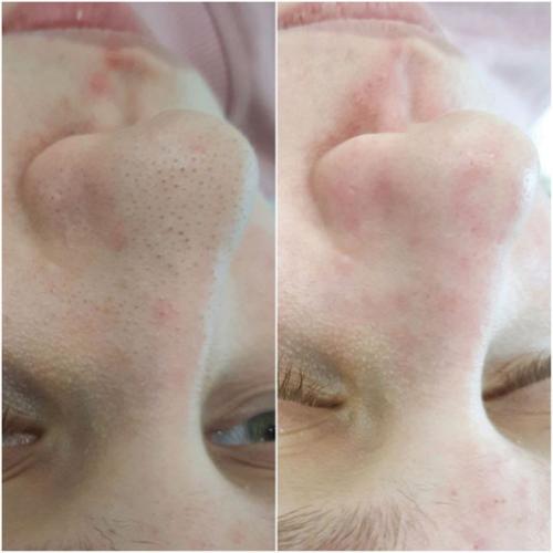 Комбинированная-чистка-лица-Доценко-Лилия-Григорьевна2