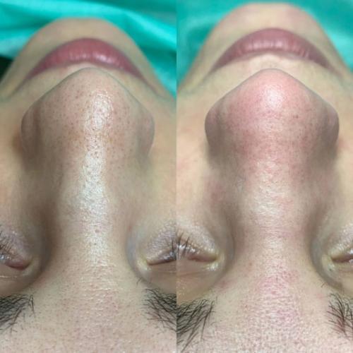 Комбинированная-чистка-лица-Оводенко-Наталья-Вячеславовна