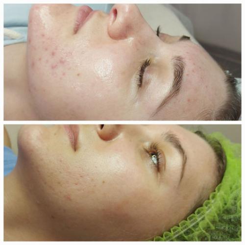 Курс-хімічних-пілінгів-домашній-догляд-Литвин-Світлана-Миколаївна