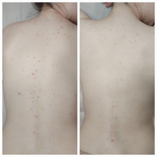 Курс-хімічних-пілінгів-домашній-догляд-Литвин-Світлана-Миколаївна2