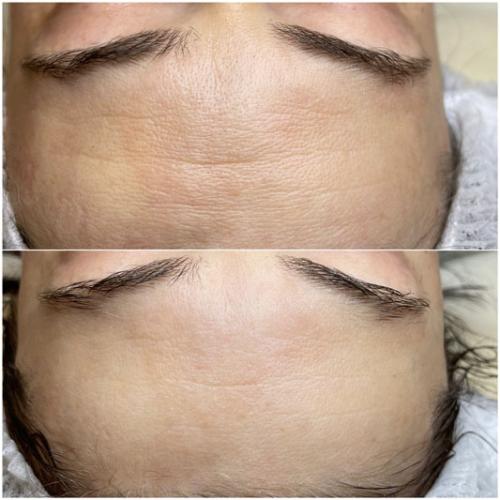 Пілінг-PRX-t33-Бесєда-Тетяна-Павлівна