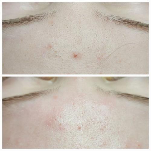 Чистка-обличчя-Литвин-Світлана-Миколаївна