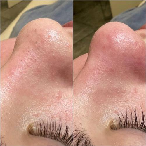 Чистка-обличчя-Щербина-Анна-Леонідівна